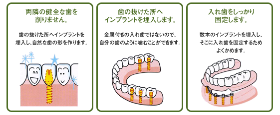 両隣の健全な歯を削りません。歯の抜けた所へインプラントを埋入します。入れ歯をしっかり固定します。